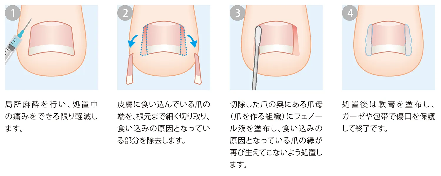 爪の治療_フェノール法
