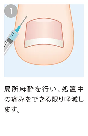 局所麻酔