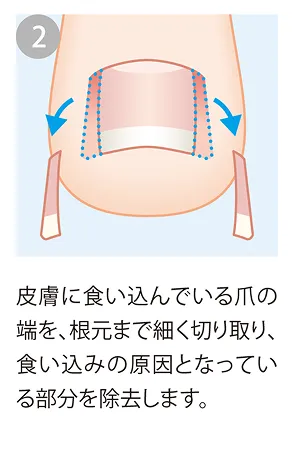 食い込み部分を除去