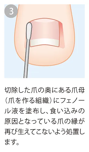 フェノール液を塗布