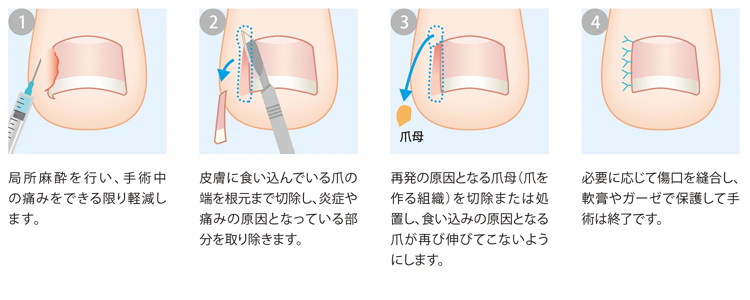 爪の手術