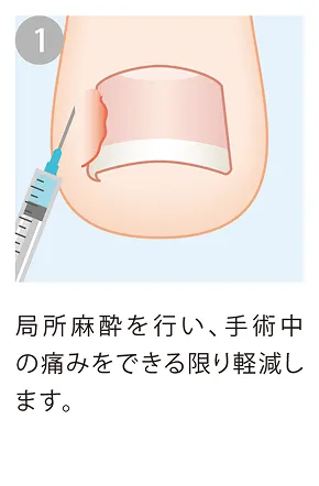 局所麻酔