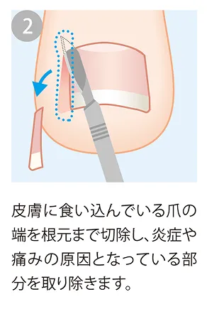 食い込み部分を除去
