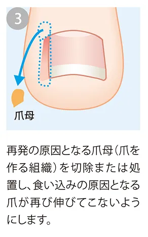 爪母を除去または処置