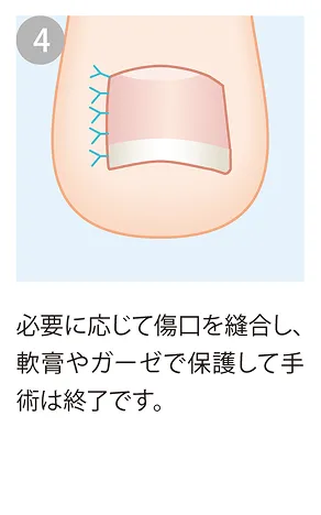 傷口を縫合